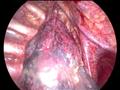 صورة من كاميرا المنظار أثناء الجراحة داخل صدر المريض                                                                                                                                                    