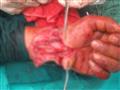 تثبيت اليد من قبل أطباء عظام في الفريق الطبي المعاللج لهذه الحالة                                                                                                                                       