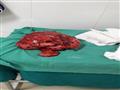 استئصال ورم سرطاني يزن  8 كيلو من بطن طفل  في مستشفى الطلبة بالإسكندرية (7)                                                                                                                             