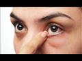   تعرف على أسباب أحمرار العين.. وهذه طرق علاجها