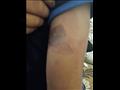 أثار كدمات من التعذيب على ذراع طفل