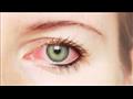 تحذير: مكونات المكياج قد تسبب التهاب العين