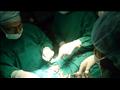 الفريق الجراحي أثناء استخراج جنين من بطن أخيه (2)