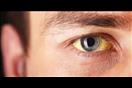 علامة نادرة في العين تكشف الإصابة بـ السرطان
