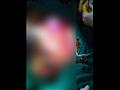 فريق طبي ينقذ طفلًا سقط على سيخ حديدي في طنطا