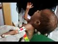  طفل يمني يعاني من سوء التغذية في حجة في 5 تموز/يو