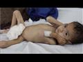 طفلة افغانية تعاني سوء التغذية