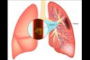 الانسداد الرئوي