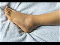 تجاهل هذه الأعراض في الساق يؤدي إلى زيادة احتمالية البتر 