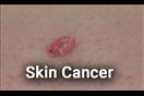 سرطان الجلد