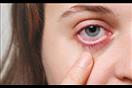 أمراض العيون النادرة