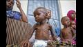 سوء التغذية في السودان