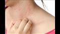 الصبغات الاصطناعية التي تحتوي عليها قد تسبب التهيج والنتوءات والطفح الجلدي