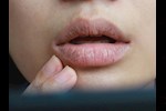 مرارة الفم                                        