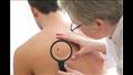 أين يتطور سرطان الجلد ؟