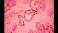 المركز الثالث لصورة تظهر خلايا سرطان الثدي