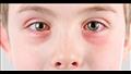 وباء العين الوردية