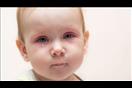 7 أسباب لتورم عين الرضع.. هل تهدد الطفل؟