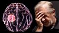 أعراض ورم الدماغ
