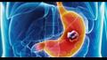 سرطان القولون والمستقيم