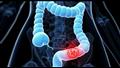 أعراض سرطان القولون والمستقيم