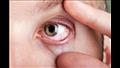  حالة السكر في الدم يمكن أن تسبب عدم وضوح الرؤية في عينيك على المدى القصير والطويل.