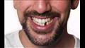 تفسير سقوط الأسنان في المنام
