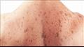 أعراض سرطان الجلد 