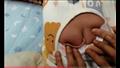 وُلد طفل صيني بذيل طوله أربع بوصات (أي ما يعادل 10سنتيمتر)
