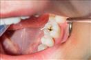 س & ج- دليل شامل عن تسوس الأسنان بعد الحشو