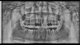 أشعة مقطعية وأخرى بانوراما بعد الزرع وتدهور حالة الفك والأسنان 