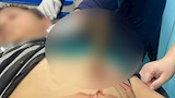 أطباء بمستشفى المنصورة الدولى ينجحون فى استخراج سك