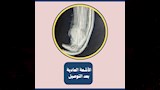 طب طنطا تنجح في إعادة توصيل يد مبتورة بعد 3 ساعات من فصلها (3)