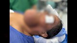 إزالة ورم من فك مريضة