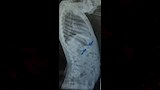 استخراج دبوس من معدة طفل