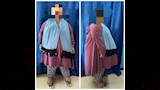 نجاح أول عملية تكميم معدة لطفلة 