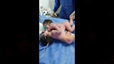 جراحة دقيقة لولادة توأم ملتصق 