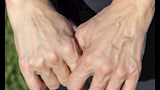 ظهور عروق اليد البارزة