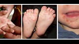 مرض اليد والقدم والفم