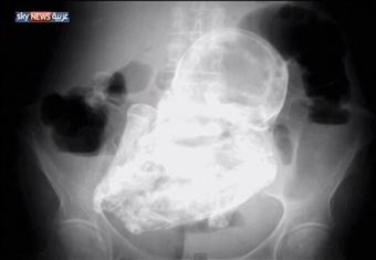 جنين يستقر في بطن أمه الكولومبية 40 عاماً