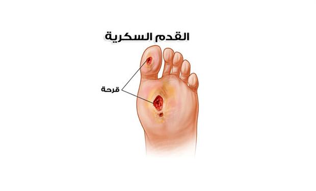 تلف الأعصاب يتطلب فحصاً يومياً لقدم مريض السكري