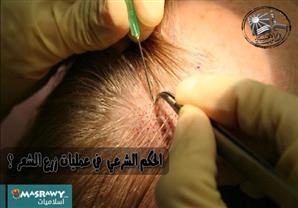 ما حكم الشرع في عمليات زرع الشعر ؟