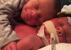 قصة صورة رضيع احتضن "توأمه" المتوفى!