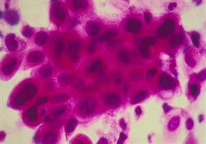 علماء: نوع معين من بكتيريا الأمعاء يزيد من خطر الإصابة بسرطانها.. دليلك للوقاية