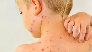 بعد تسجيل إصابات بين طلاب المنوفية.. ما هو الجدرى المائى وأعراضه وطرق الوقاية منه؟