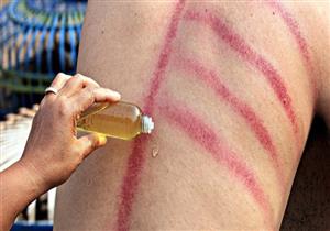 أغرب 5 طرق للعلاج في العالم.. منها العملات المعدنية وثَقب الجمجمة‎