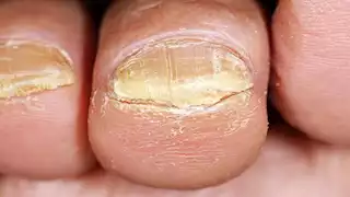 ما هي أسباب الإصابة بفطريات الأظافر؟- و4 طرق للوقاية 
