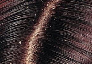 وصفة طبيعية للتخلص من قشرة الشعر 