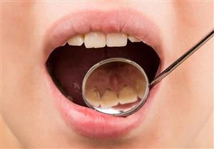 طرق بسيطة تخلصك من الرواسب السوداء على الأسنان