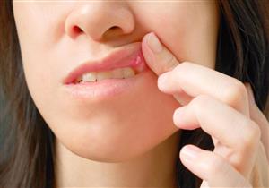 مرضى الكلى أكثر عُرضة لالتهابات أنسجة الفم.. كيف تتجنب ذلك؟